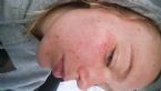 rosacea? acne? allergy?