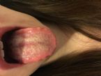 White residue in tongue bad breath