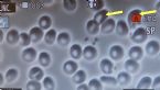 Blood cell sample august 201505