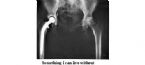 250px 746px Hip replacement Image 3684 PH jpg