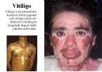 Vitiligo face