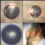 Microscopic Photos of an Ova, Cyst, Egg from Threadworm, Demodex or ???