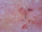 larvae worms in lesion ... (Click to enlarge)