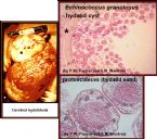 cerebral hydatidosis ... (Click to enlarge)