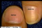 diabetes nail ... (Click to enlarge)