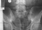 hip xray sample ... (Click to enlarge)