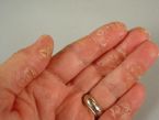 eczema left hand 1 ... (Click to enlarge)