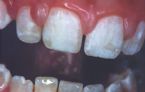 mild dental fluorosis ... (Click to enlarge)