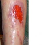 MRSA on Kerie's leg ... (Click to enlarge)