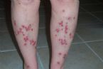 morgellons infection  legs ... (Click to enlarge)