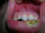 My gums are also irritated ... (Click to enlarge)