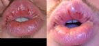 lip scab ... (Click to enlarge)