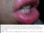 exfoliative cheilitis - Day 0 ... (Click to enlarge)