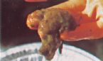 Mucoid Plaque. Photo from Dr. Jensen's  Bowel Man ... (Click to enlarge)