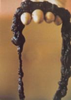 Mucoid Plaque. Photo from Dr. Jensen's  Bowel Man ... (Click to enlarge)