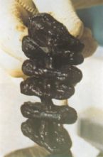 Mucoid Plaque. Photo from Dr. Jensen's  Bowel Man ... (Click to enlarge)