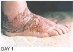 Skin Healing, Psoriasis Gangrene, Dr. Jensen's  B ... (Click to enlarge)