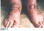 Skin Healing, Psoriasis Gangrene, Dr. Jensen's  B ... (Click to enlarge)