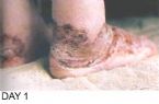 Skin Healing, Psoriasis Gangrene, Dr. Jensen's  B ... (Click to enlarge)