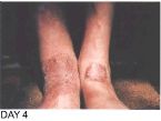 Skin Healing, Psoriasis Gangrene, Dr. Jensen's  B ... (Click to enlarge)