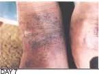 Skin Healing, Psoriasis Gangrene, Dr. Jensen's  B ... (Click to enlarge)