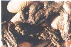 Mucoid Plaque. Photo from Dr. Jensen's  Bowel Man ... (Click to enlarge)