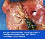 gallbladder_removed ... (Click to enlarge)