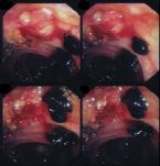 gallbladder surgery ... (Click to enlarge)