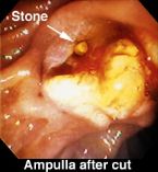 gallbladder surgery ... (Click to enlarge)