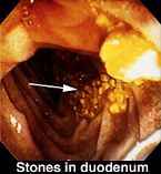 gallbladder surgery ... (Click to enlarge)