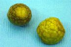 gallstones from the gallbladder ... (Click to enlarge)