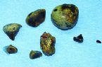 gallstones from the gallbladder ... (Click to enlarge)