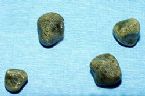 gallstones from the gallbladder ... (Click to enlarge)