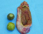 gallstones from the gallbladder ... (Click to enlarge)