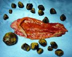 gallstones from the gallbladder ... (Click to enlarge)