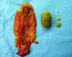 gallstones from the gallbladder ... (Click to enlarge)