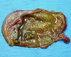 gallstones from the gallbladder ... (Click to enlarge)