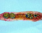 gallstones from the gallbladder ... (Click to enlarge)