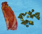 gallstones from the gallbladder ... (Click to enlarge)