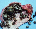 gallstones from the gallbladder ... (Click to enlarge)