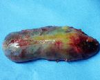 gallstones from the gallbladder ... (Click to enlarge)