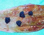 gallstones from the gallbladder ... (Click to enlarge)