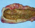 gallstones from the gallbladder ... (Click to enlarge)