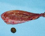 gallstones from the gallbladder ... (Click to enlarge)