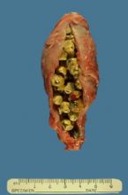 gallstones from the gallbladder ... (Click to enlarge)