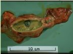 gallstones from the gallbladder ... (Click to enlarge)