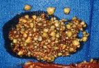 gallstones from the gallbladder ... (Click to enlarge)