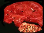 intrahepatic stones ... (Click to enlarge)