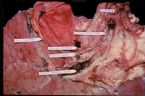 intrahepatic stones ... (Click to enlarge)