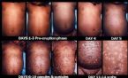 smallpox progression ... (Click to enlarge)